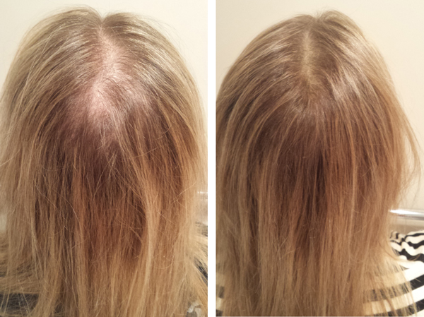 Thinning Hair In Women