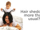 Women with hair loss post pregnancy and postpartum