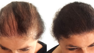 Before and after using hair thickening product Boost N Blend