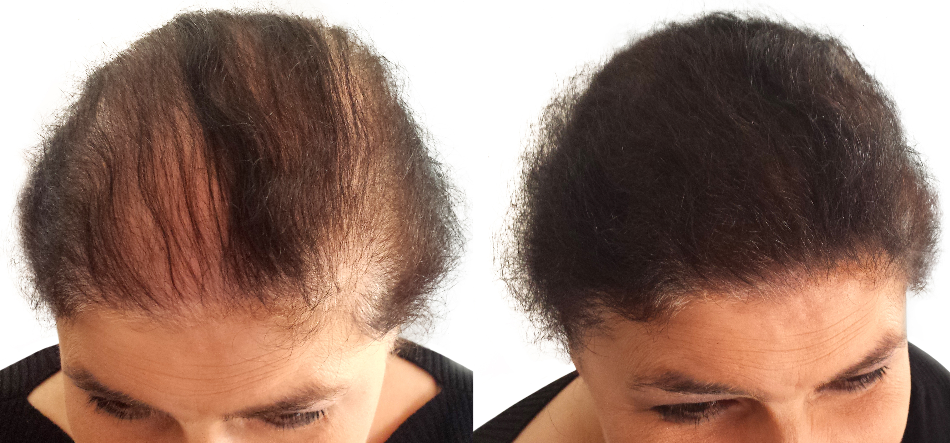 Отзывы врачей выпадение волос. Мезотерапия волос до и после. Волосы до после облысение. Пробор при выпадении волос.