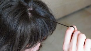 trichotillomania hair pulling