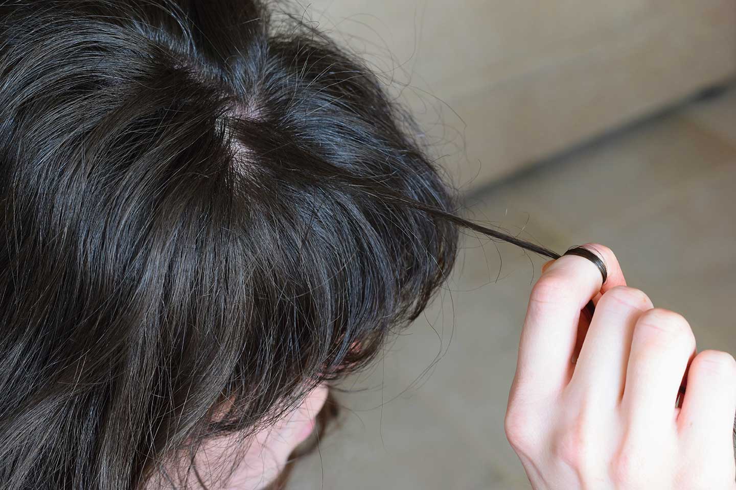 Trichotillomania Hair Pulling Disorder Causes Symptoms And Help 
