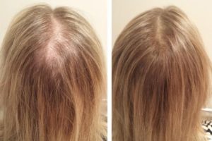 Overcome Female Hair Loss with 6 Tips for Youthful Hair